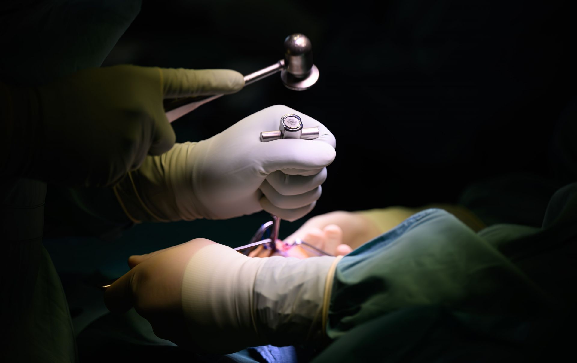 Surgery on the hand - Source: Getty